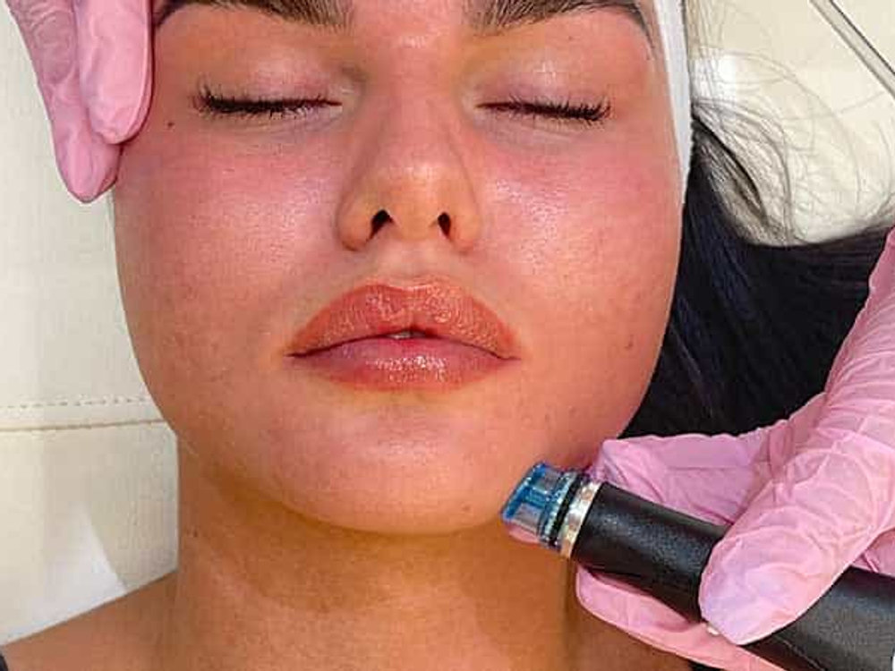 Chemical Peels