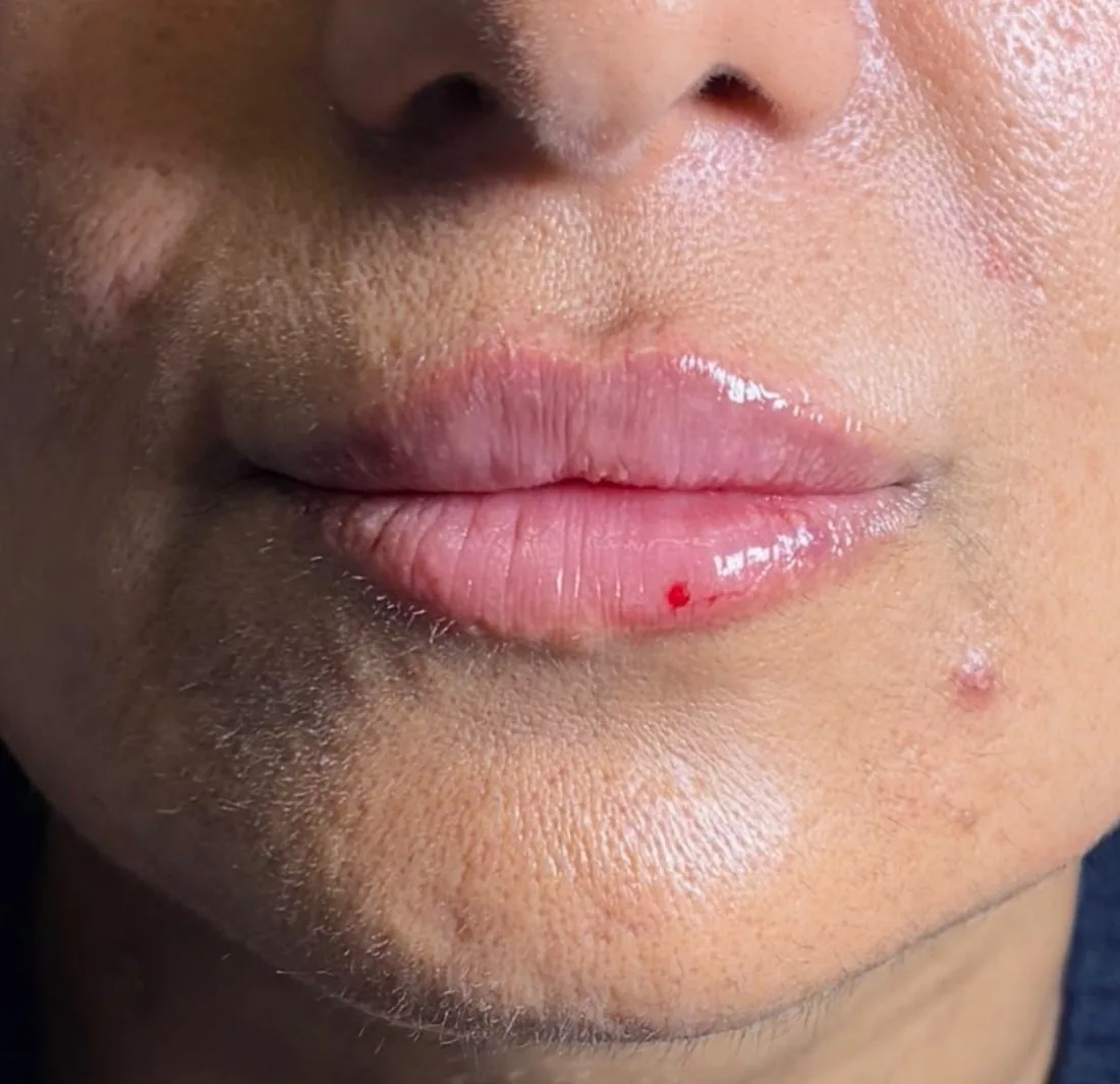 Lip filler treatment result