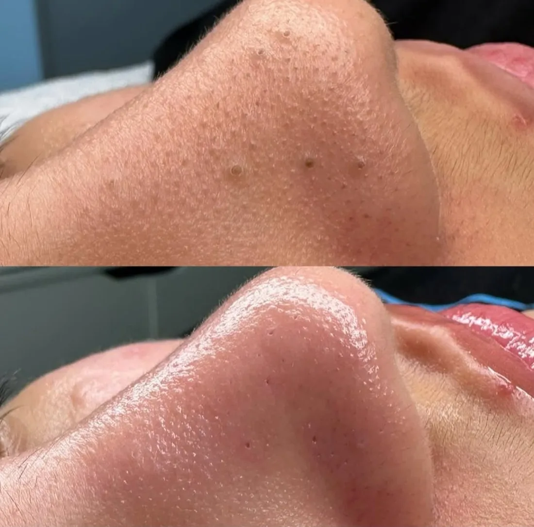 Glowing skin immediately after a HydraFacial at Rebecca Slane Skin, Alderley Edge