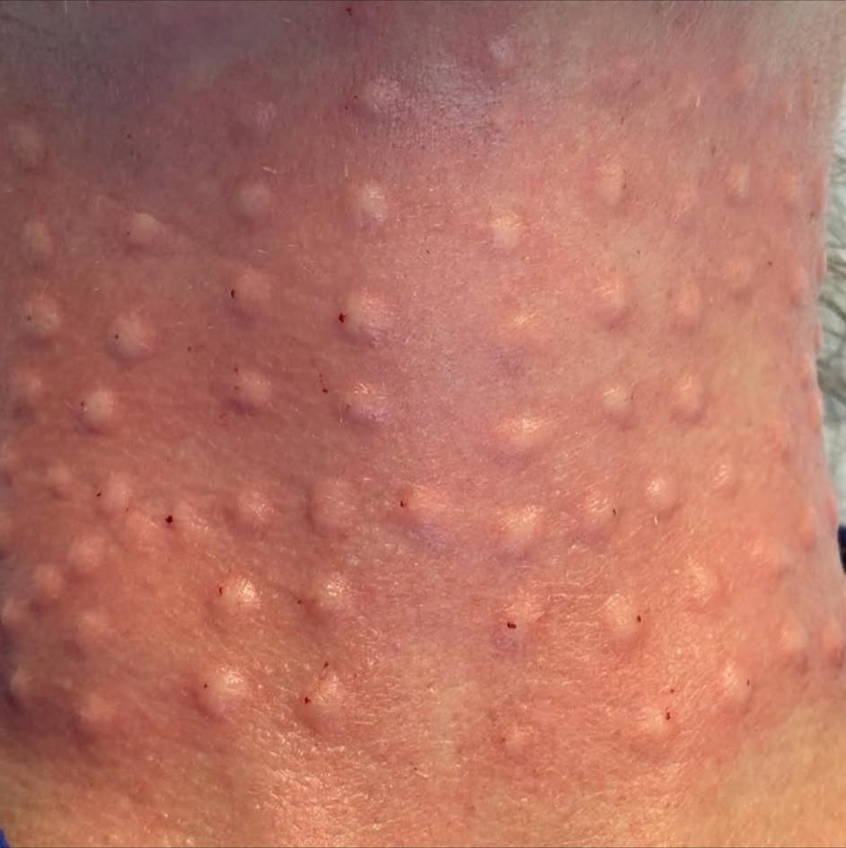 Polynucleotide skin booster treatment