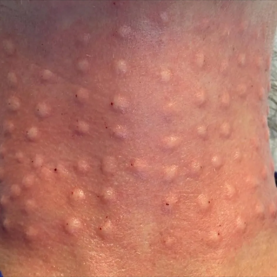 Polynucleotide skin booster treatment