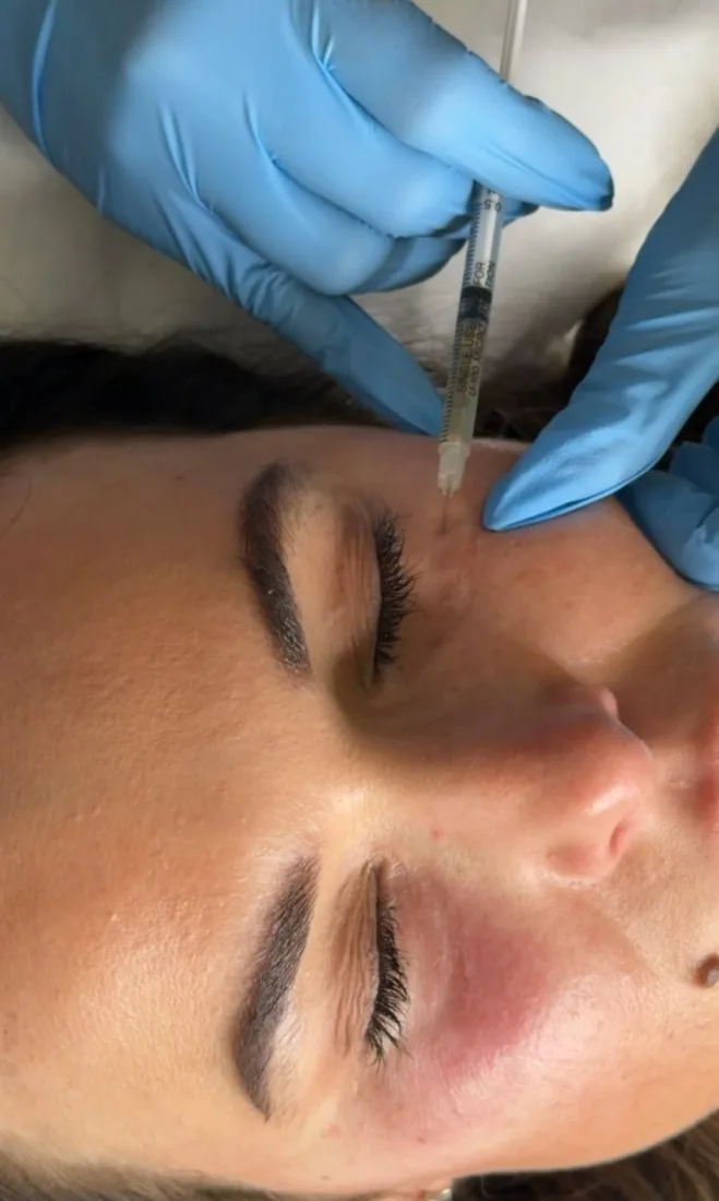 Anti-wrinkle injection treatment