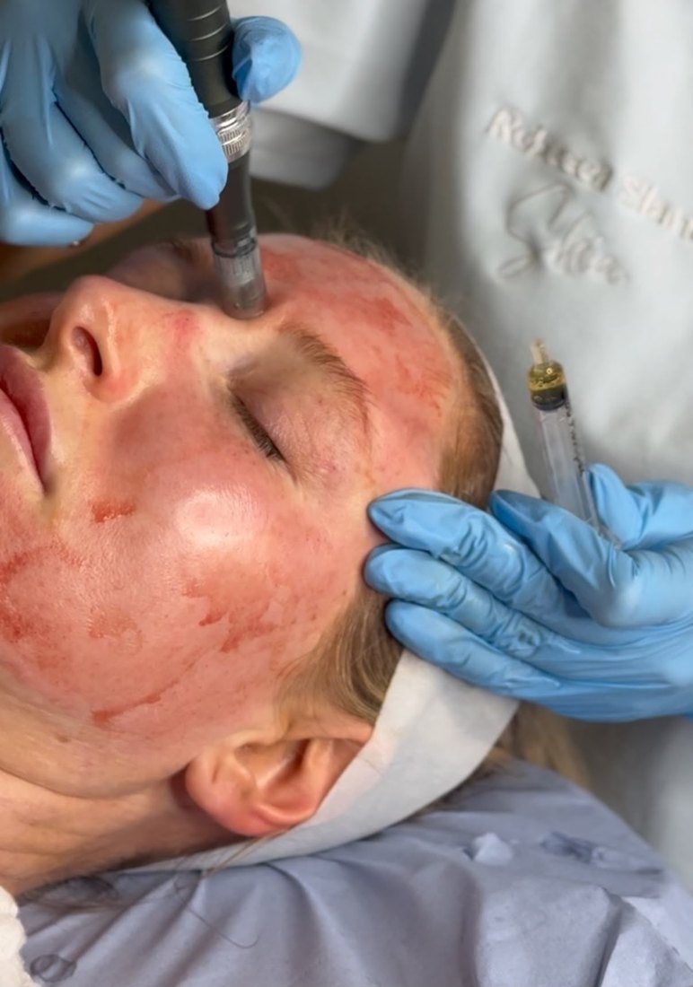 Microneedling and exosomes treatment