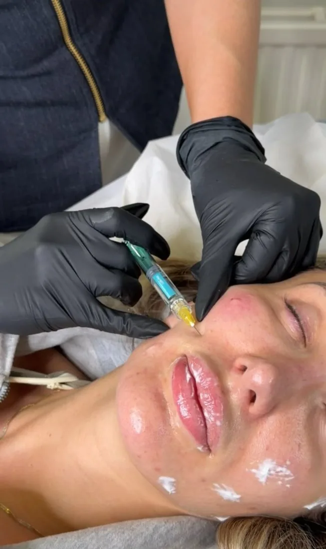 Facial injectable treatment