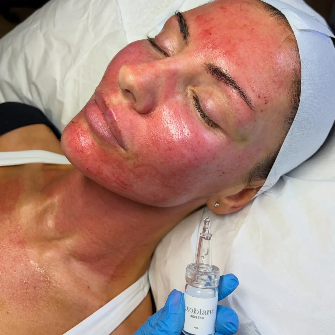 Microneedling and exosome facial