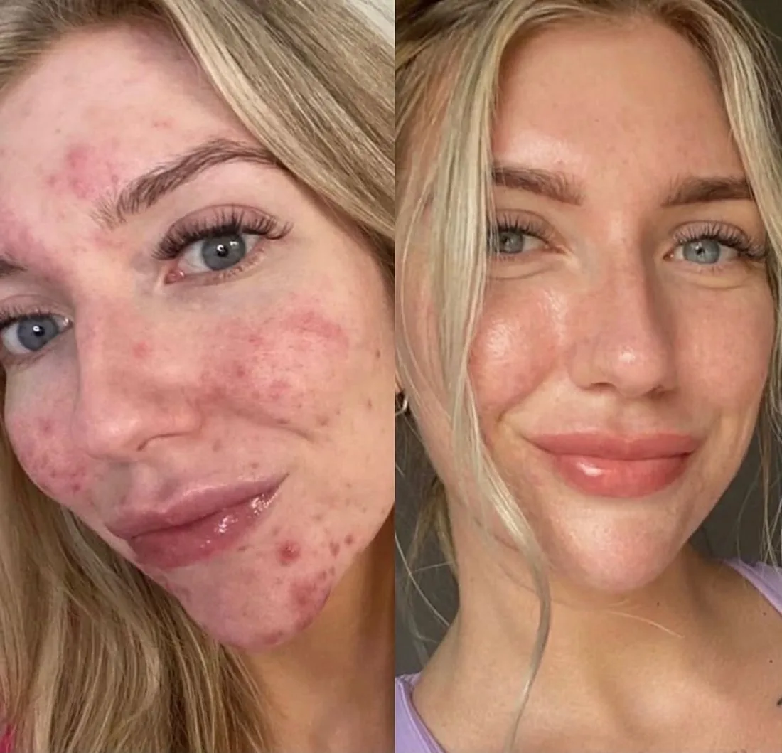 ZO® Skin Health facial skin transformation