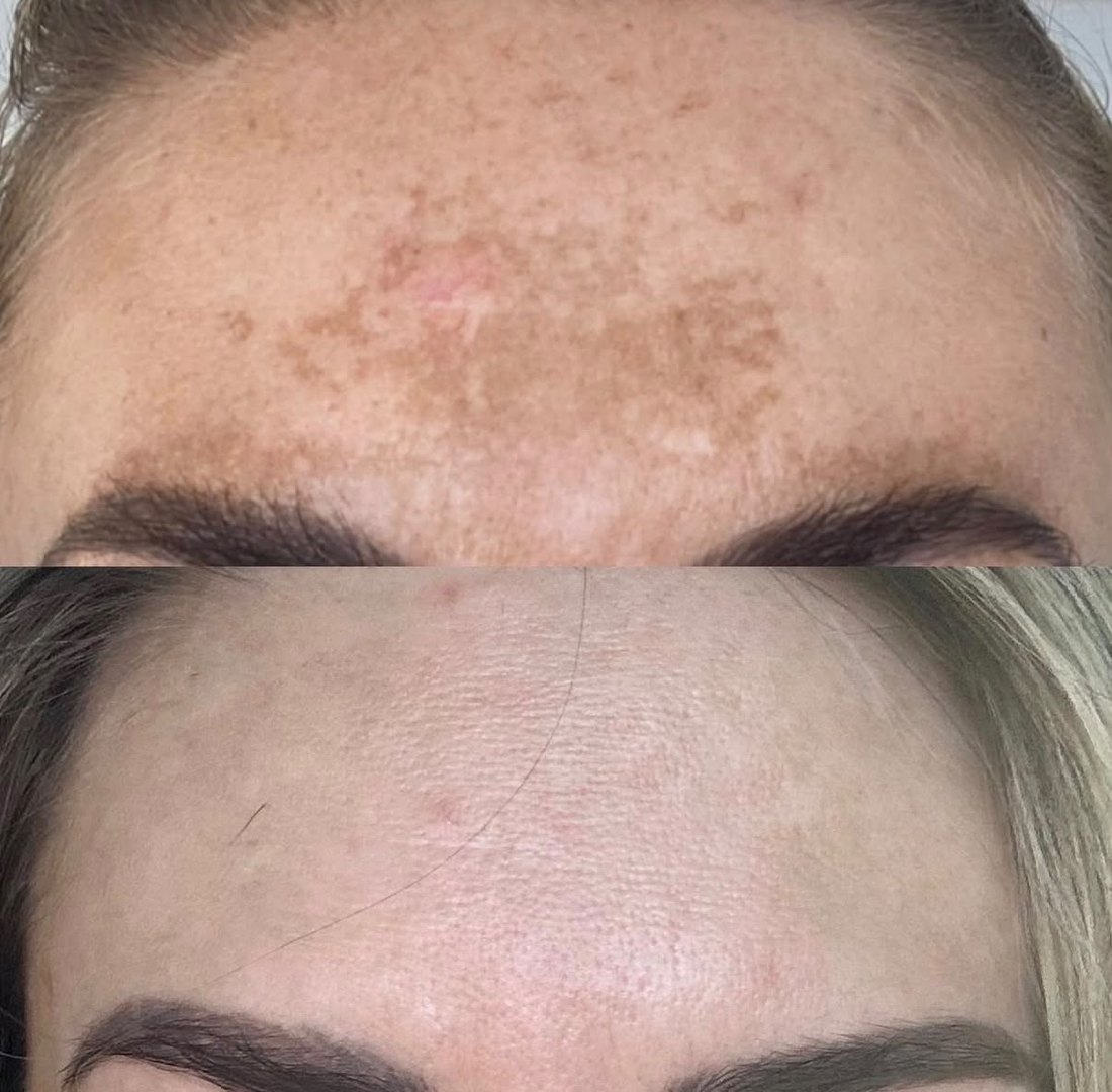 Pigmentation before and after