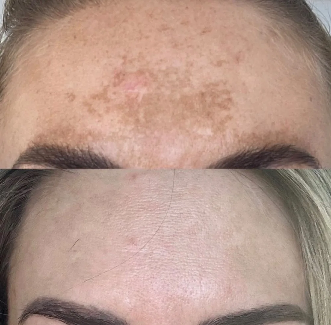 Pigmentation before and after
