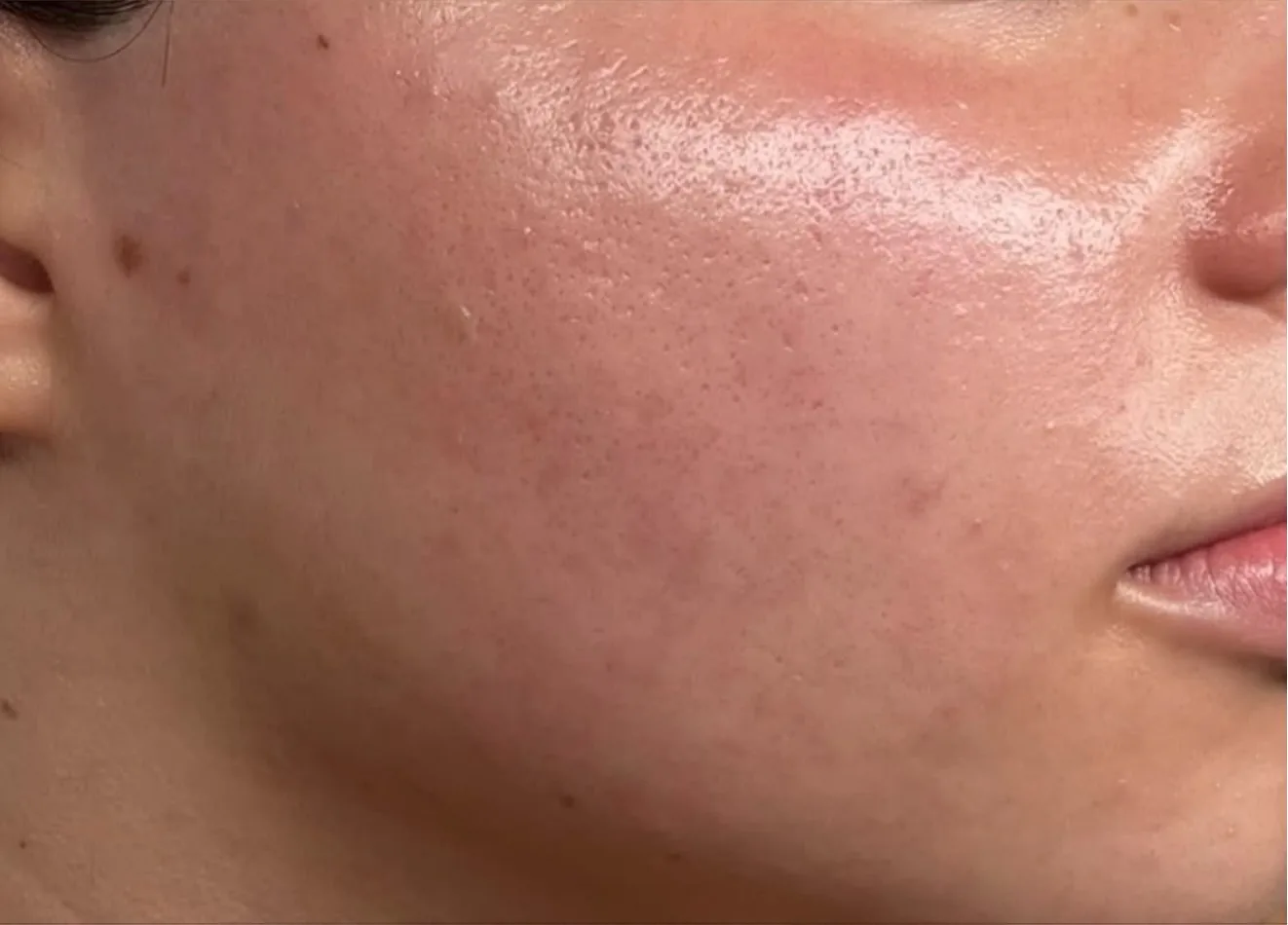 Smooth skin after dermaplaning