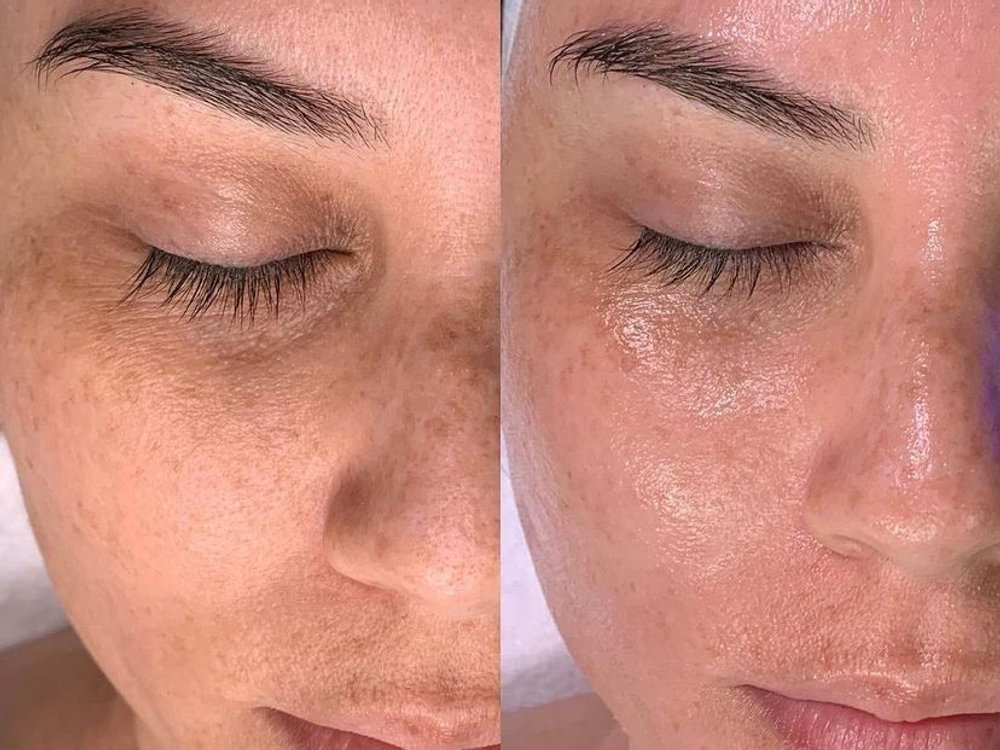 Hydrafacial
