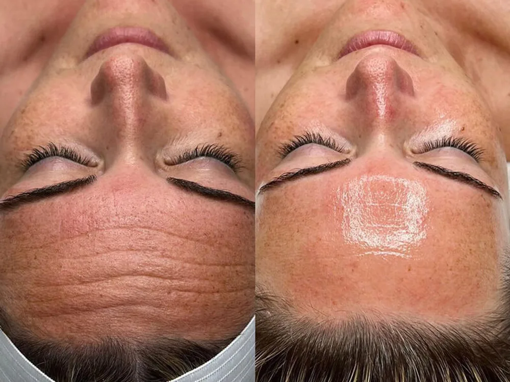 Chemical peel before and after