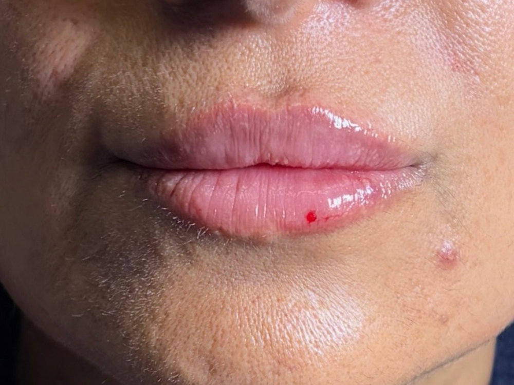 Lip Filler