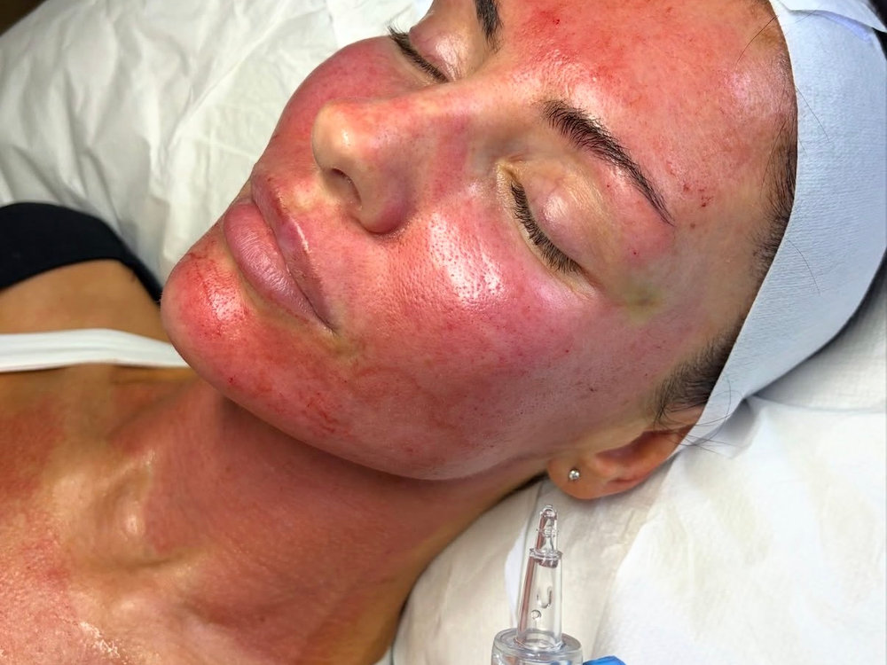 Microneedling & Exosomes