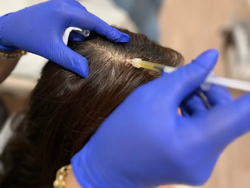 PRP Hair Rejuvenation